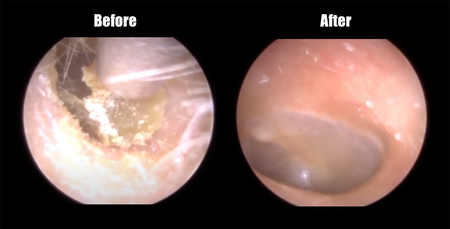 Before and after showing a dirty ear canal with impacted earwax on the left and a clean ear on the right